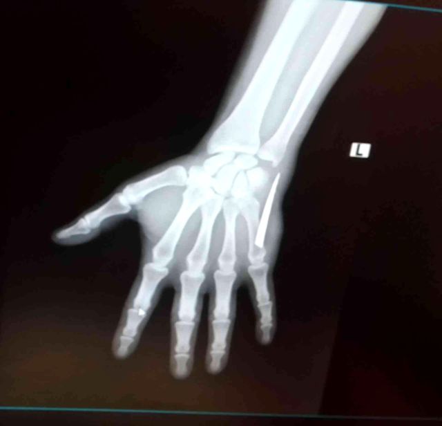 Elinin ağrısı yüzünden hastaneye giden vatandaşın röntgen sonucu ilginç gerçeği ortaya çıkardı