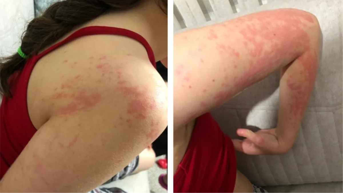 Kocaeli'de muadil ilaç krizi: Otizmli kız alerjiden hastanelik oldu